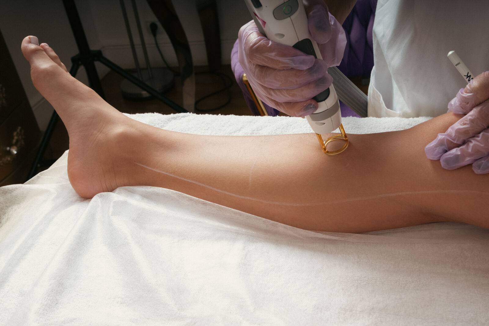Épilation laser